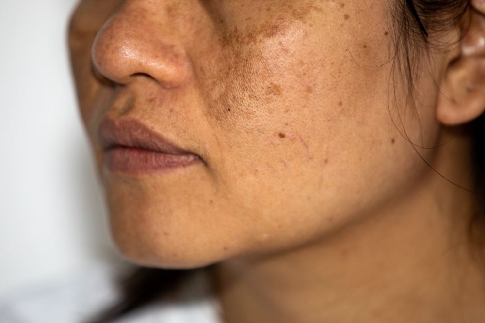 Como funciona o peeling para melasma?