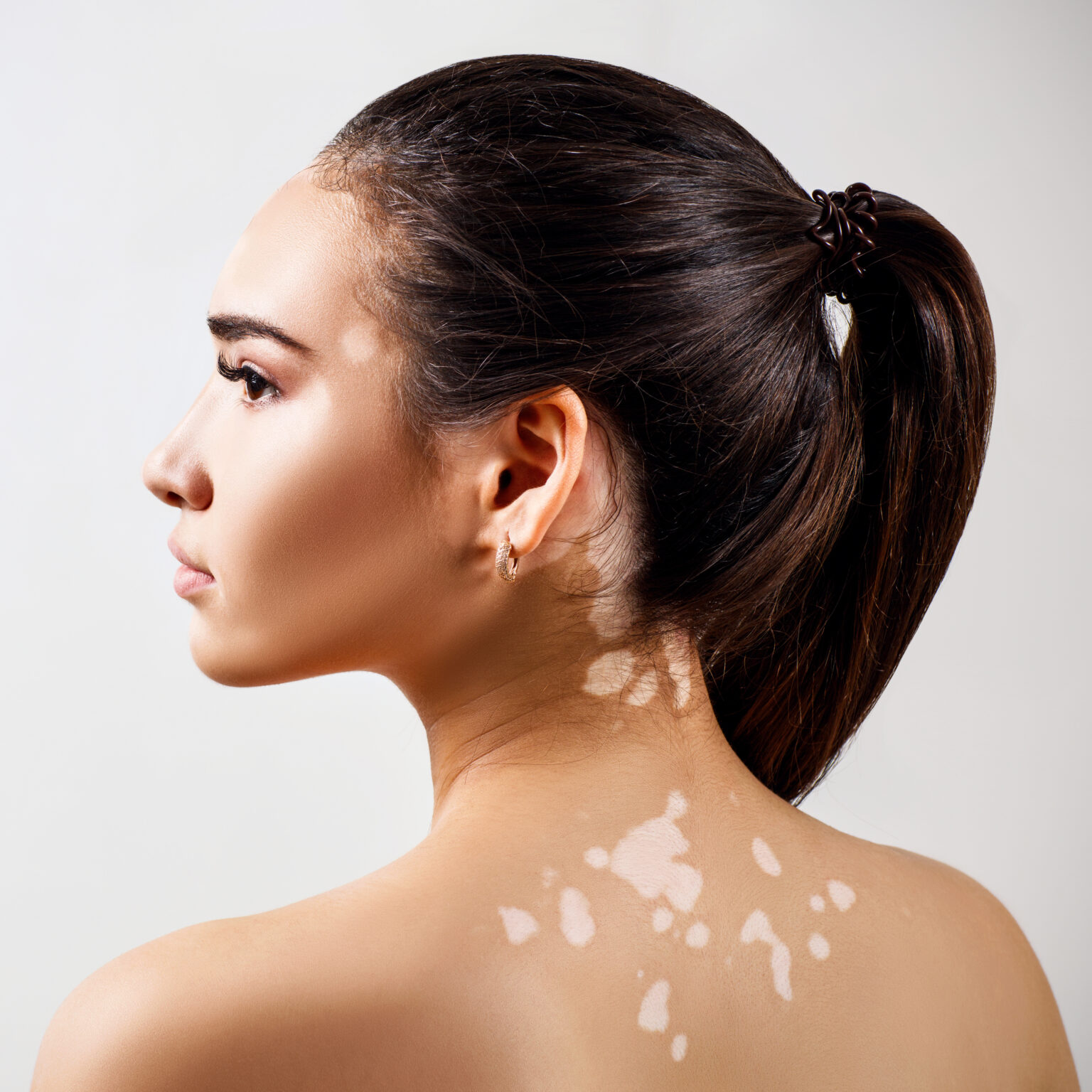 Vitiligo: sintomas, diagnóstico e tratamento - Dr. Daniel Stellin